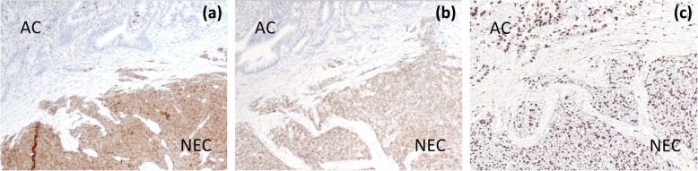 On immunohistochemical staining, NEC components were diffusely positive for a synaptophysin and b CD56, and the MIB-1 index was 30% (c)