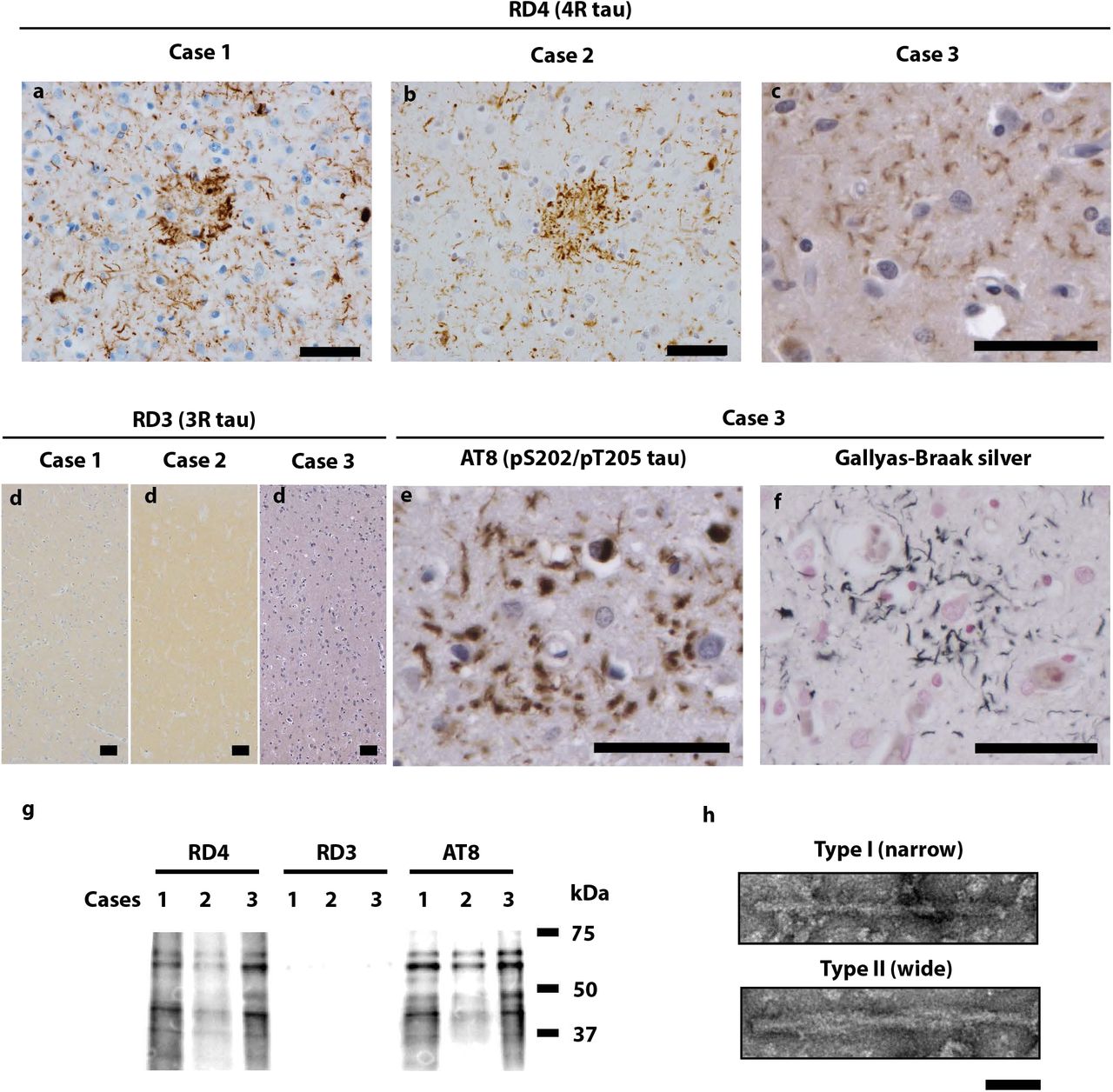 Filamentous tau pathology of CBD.(a-f), Staining of neuronal inclusions, neuropil threads and astrocytic plaques in the frontal cortex of CBD cases 1-3 by antibody RD4 (specific for 4R tau, brown) (a-c), and in the frontal cortex of case 3 by antibody AT8 (pS202, pT205 tau, brown) (e) and Gallyas-Braak silver (black) (f). Staining of frontal cortex from CBD cases 1-3 was negative when antibody RD3 (specific for 3R tau) was used (d). Nuclei were counterstained in blue. Scale bars, 50 μm. (g), Immunoblots using antibodies RD4, RD3 and AT8 of sarkosyl-insoluble tau extracted from the frontal cortex of CBD cases 1-3. (h), Negative-stain electron micrographs of Type I (narrow) and Type II (wide) tau filaments extracted from the frontal cortex of CBD case 1. Scale bar, 50 nm.