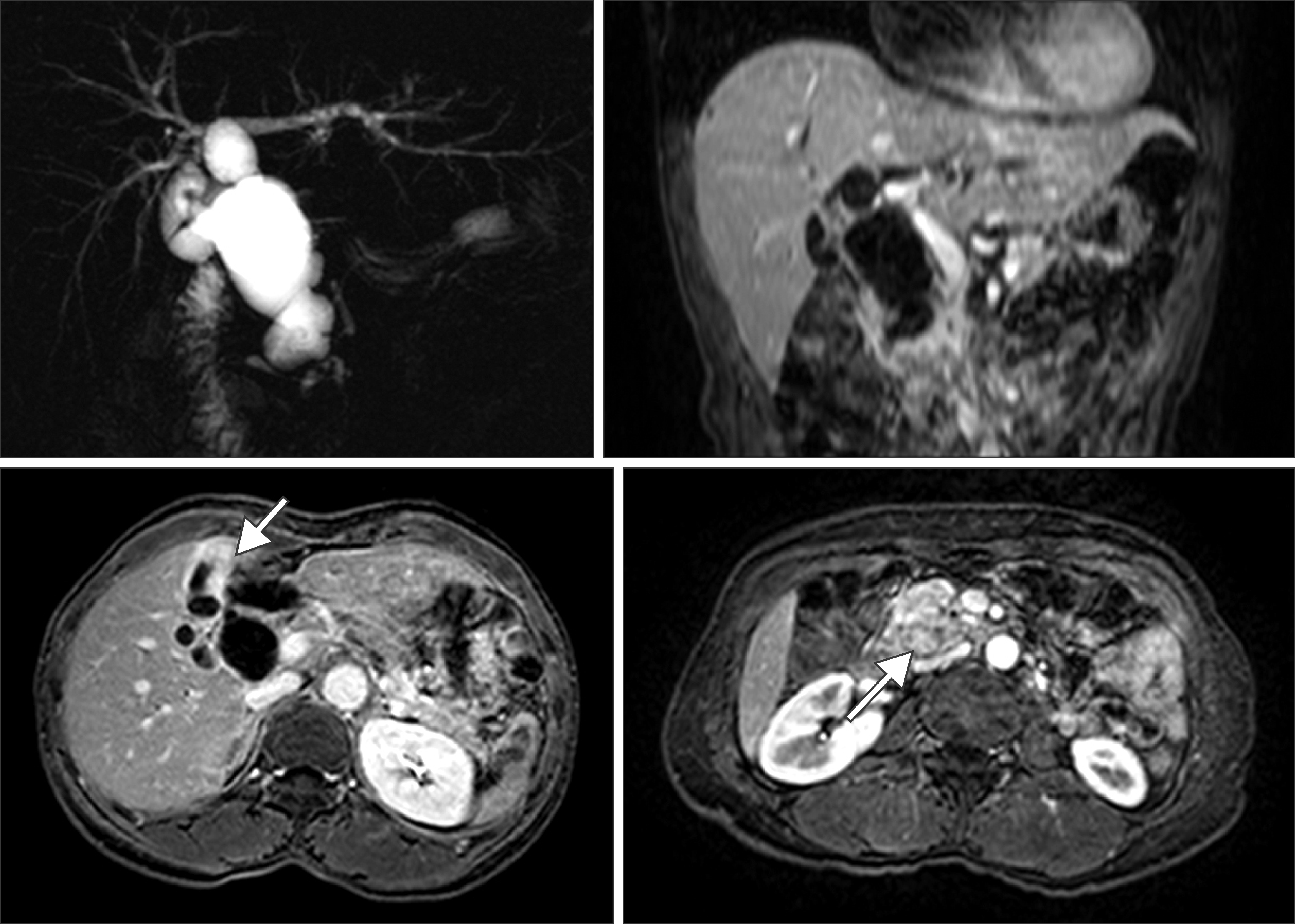 Magnetic resonance cholangiopancreatography (MRCP) image including vertical and horizontal sections. MRCP shows fusiform cystic changes involving the entire common bile duct and hilar bile duct compatible with a choledochal cyst (type Ia) associated with the long common channel of the pancreaticobiliary junction (C-P type). Irregular wall thickening at the fundus and body of the gallbladder was seen. A 2.5 × 1.9 cm mass is also seen around the pancreaticobiliary junction.