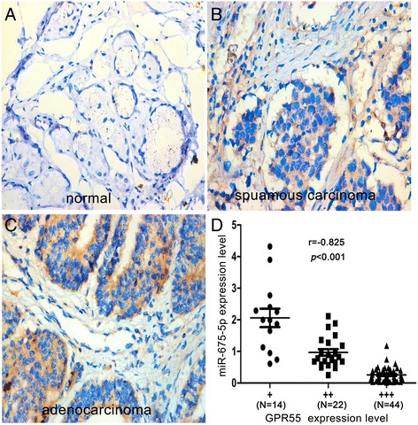 Inverse correlation between the expression of GPR55 and miR-675-5p in clinical specimens of NSCLC. (A, B, C) The expression of GPR55 was assessed in normal and NSCLC tissues using immunohistochemistry. The images were representative IHC of GPR55 in normal, squamous carcinoma, and adenocarcinoma, respectively. (D) A scatter diagram showed an inverse correlation between the expression of miR-675-5p and GPR55 in the same set of NSCLC tissue specimens. (original magnification ×400).