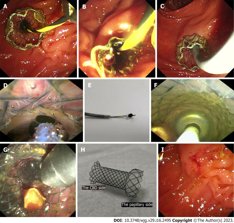 The procedures of cholangioscopy-assisted extraction through novel papillary support for small-calibre and sediment-like common bile duct stones. A: The novel papillary support was placed in the lower common bile duct (CBD) and papilla; B: Many sediment-like CBD stones flowed from the support under endoscopic aspiration; C: The cholangioscope (Micro-Tech, eyeMax) was inserted into the CBD; D: The single clumpy CBD stone was collected by the basket under cholangioscopy; E: The stone, collected by the basket, was extracted from the CBD and body along with the cholangioscope; F: Multiple clumpy CBD stones were held by the balloon under cholangioscopy; G: One stone, held by the balloon, was extracted from the CBD along with the cholangioscope; H: The novel single dumbbell-style papillary support was removed from the body; I: Papillary morphology immediately after the removal of papillary support.