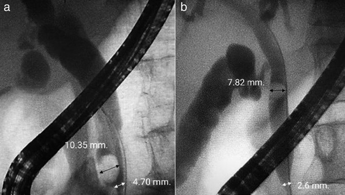 Cholangiography and measurement of stone (black arrow) and distal CBD (white arrow) diameter. (a) Oval‐shaped CBD stone diameter 10.35 mm; distal CBD diameter 4.70 mm. (b) Round‐shape CBD stone diameter 7.82 mm; distal CBD diameter 2.6 mm.