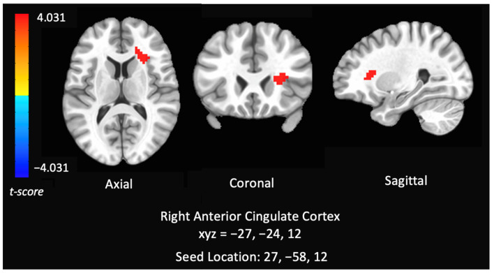 Group analysis of connectivity within the dorsal attention network of controls versus chronic cannabis users. Comparison of whole-brain resting state functional connectivity of controls versus chronic cannabis users with seed regions within right inferior parietal sulcus. The colors represent areas of significant connectivity; warm colors indicate increased connectivity in controls compared to cannabis users. The axial, coronal, and sagittal views are featured (left = left).