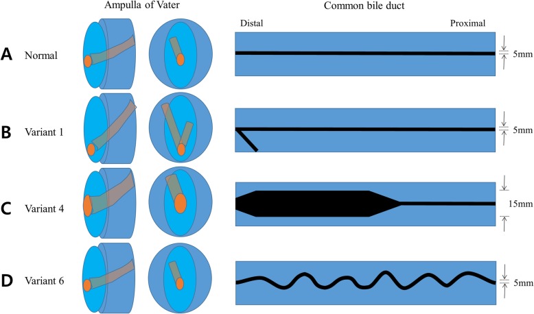 Concepts for the ampulla of Vater and common bile duct (CBD) shapes. a Normal type: The ampulla orifice is located in the middle of the area and the width is 5 mm. The CBD is located at 11 o’clock and the width remains constant at 5 mm; b Variant 1: The ampulla orifice is located at the very bottom and is designed to cause cannulation difficulty. A short pancreatic orifice is also created for double guidewire method; c Variant 4: The ampulla orifice is expanded to facilitate stone removal. The distal CBD is extensively expanded so that stone insertion and stone movement are free; d Variant 6. The width of the CBD is constant, but the direction is very wavy and is designed to induce difficult guidewire insertion