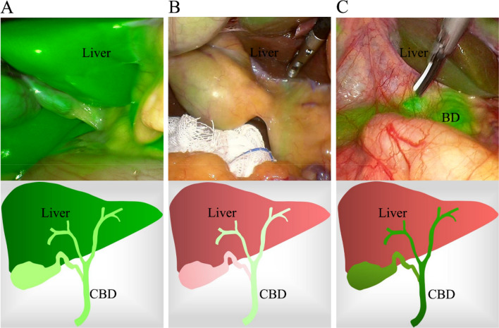 Effect of ICG injection dose or dosing time on FC. A The liver is highly fluorescent, while bile ducts did not yet contain enough ICG to locate the biliary tract. B Both the FI of the CBD and liver were so low that they could not be used to identify anatomical structures. C Bile ducts were highly fluorescent, while liver tissue in the background exhibited a low fluorescence signal