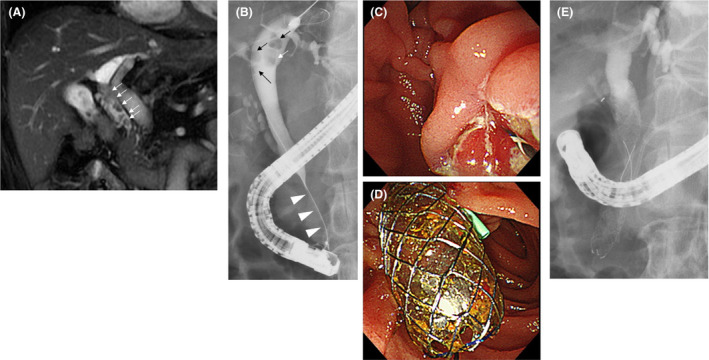The clinical course until the first endoscopic retrograde cholangiopancreatography (ERCP). A, Common bile duct (CBD) stones (arrow) were detected on magnetic resonance cholangiopancreatography. B, In addition to the CBD stones (arrow), distal CBD stricture (arrowhead) was observed on endoscopic cholangiography. C, After cholangiography, endoscopic sphincterotomy was performed. D, E, A covered self‐expandable metallic stent was placed to dilate the distal CBD stricture after the pancreatic stent was inserted to prevent post‐ERCP pancreatitis