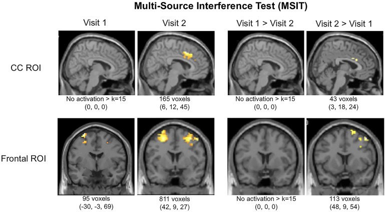 Functional magnetic resonance imaging (fMRI) activation in cingulate cortex (CC) and frontal regions of interest (ROIs) during the MSIT (Interference-Control). Local maxima and total k (voxels activated within ROIs per contrast) are displayed below images.