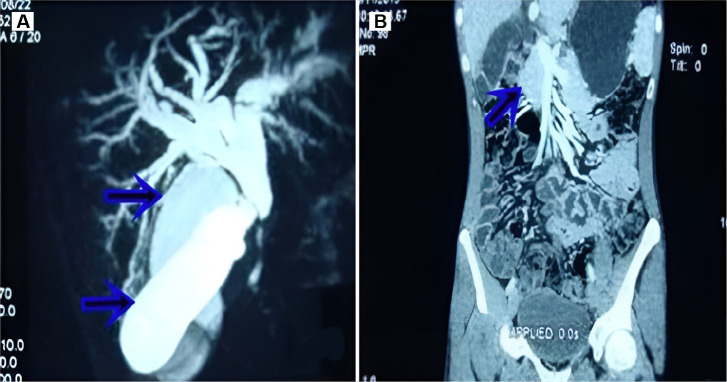(A) MRCP Image showing a distended double gallbladder with dilated intrahepatic biliary radicals and common bile duct with a block just below the cystic duct and common bile duct junction (arrow). (B) Coronal section of a contrast-enhanced CT scan showing diffuse annular thickening of the lower third common bile duct. MRCP, magnetic resonance cholangiopancreatography.