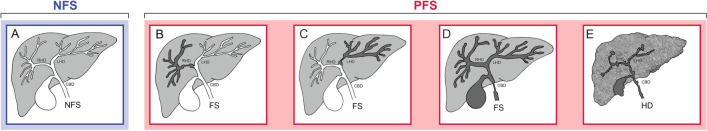 Scheme demonstrates (A) normal biliary contrast excretion (white) in a PSC patient with no functional stricture (NFS). No contrast opacification (dark gray) is seen in a functional stricture (FS) in (B) the right hepatic duct, (C) the left hepatic duct, and (D) the hilum. E Hepatocellular dysfunction (HD) in very advanced PSC with cirrhosis as noted by the pruned tree appearance of the bile ducts and the shrunken nodular rim of the liver