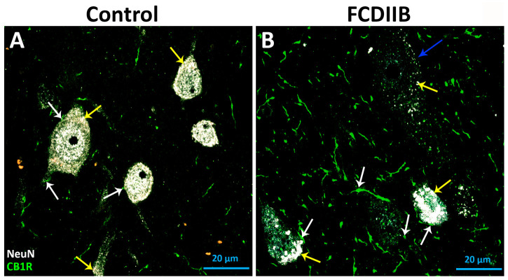 NeuN-CB1R double-immunostained cells in the prefrontal cortex of control (A) and FCDIIB (B) epileptic subjects in layer 3 with confocal fluorescence imaging. White arrows: CB1R-containing elements, forming presumable synapses; blue arrows: presumable dysmorphic neuron; yellow arrows: autofluorescent lipofuscin drops. It is the consequence of non-specific binding that the red blood cells appear in orange. Scales: 20 μm.