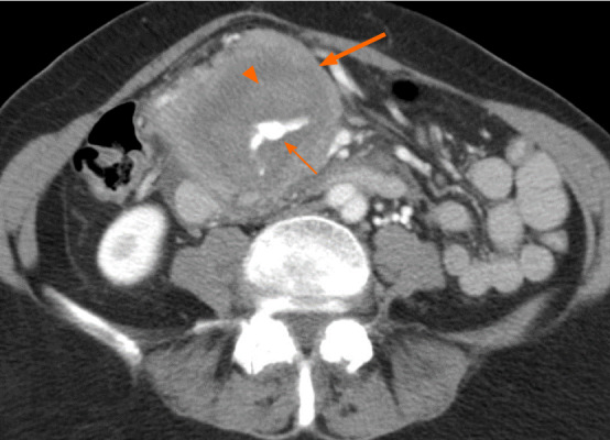 A 74-year-old female presenting with abdominal pain and nausea. Axial computed tomography shows mass (thick arrow) encircling an aneurysmal vessel (thin arrow) which is bleeding into the mass, causing hematoma (arrowhead). The tumor was biopsy-proven to be primary pancreatic lymphoma.