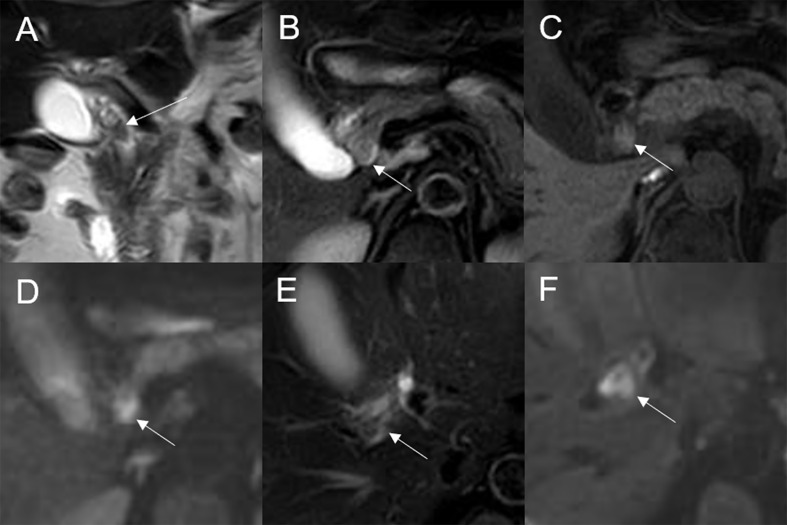 Malignant transformation of adenoma in the common bile duct. The eccentric mass with a frond-like superficial appearance (white arrow) shows hyperintensity on T2WI (A, B), isointensity on T1WI (C), and hyperintensity on DWI (D). The bile duct wall (white arrow) surrounding the lesion, without any abnormal signal on T2WI (E), shows hyperintensity on DWI (F).