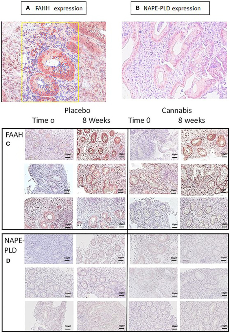 FAAH and NAPE-PLD expression in colon biopsies. (A, C) FAAH and (B, D) NAPE-PLD expression were evaluated in colon biopsies using immunohistochemistry. The expression of the proteins in the images was measured using QuPath digital analysis tool. Presented are representative pictures of colon biopsies stained with (A) anti-FAAH and (B) anti-NAPE-PLD. The yellow square in panel (A) illustrates a QuPath reading. The red markings indicate a positive staining for FAAH, while the blue ones indicate staining with hematoxylin. (C, D) Images of FAAH and NAPE-PLD staining from three patients treated with placebo or cannabis at the beginning of the experiment and 8 weeks later.