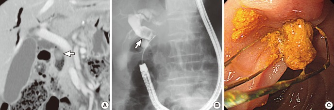 Removal of common bile duct (CBD) stone. Follow-up computed tomography scan taken about 6 months after enterolith removal shows an ovoid stone (white arrow) within the CBD (A). CBD stone (white arrow) removed by Dormia basket (B) proved to be brown pigment sludge stone (C).