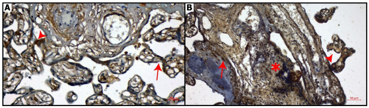 CNR1 immunostaining of placental sections. (A): Control group: Weak expression of CNR1in chorionic villi (arrow), syncytial knots (arrowhead), Bar: 20 μm (magnification: 40×), (B): COVID-19 group: Intense expression of CNR1 in decidual cells (arrow), syncytial knots (arrowhead) and connective tissue (asterisk). Bar: 50 μm (magnification: 20×).