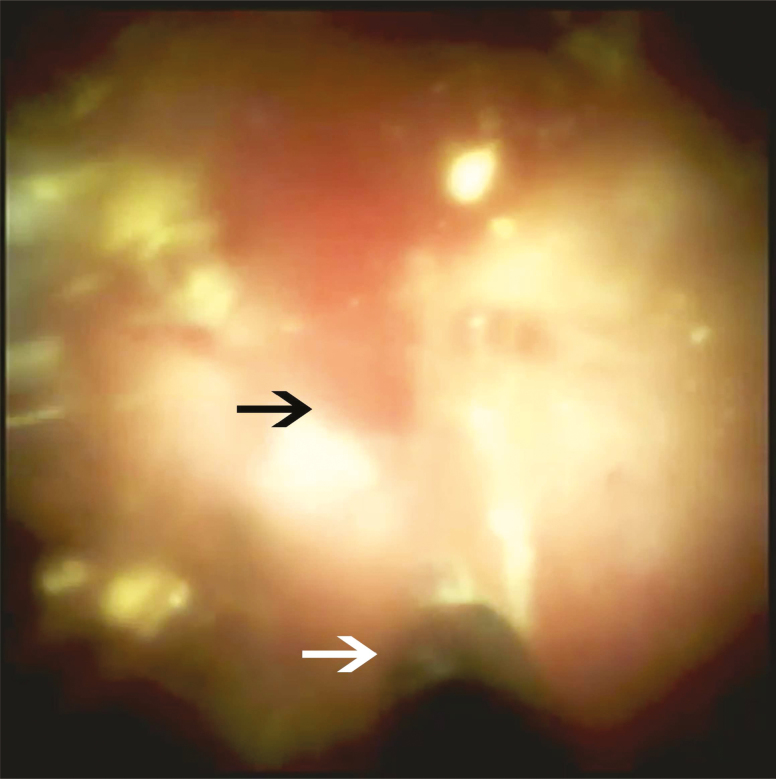 Mild trauma (black arrow) to the common bile duct from electrohydraulic lithotripsy probe (white arrow).