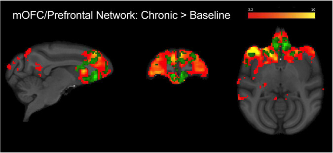 Group level (N = 4) fronto-cortical resting-state network spatial maps encompassing the mOFC, prefrontal cortex, and anterior cingulate (red-yellow). Green overlay shows regions identified using dual regression with greater connectivity during chronic AM2389 treatment relative to baseline (p < 0.05). There were no statistically significant differences between acute drug scan or discontinuation and baseline. See text for additional details.