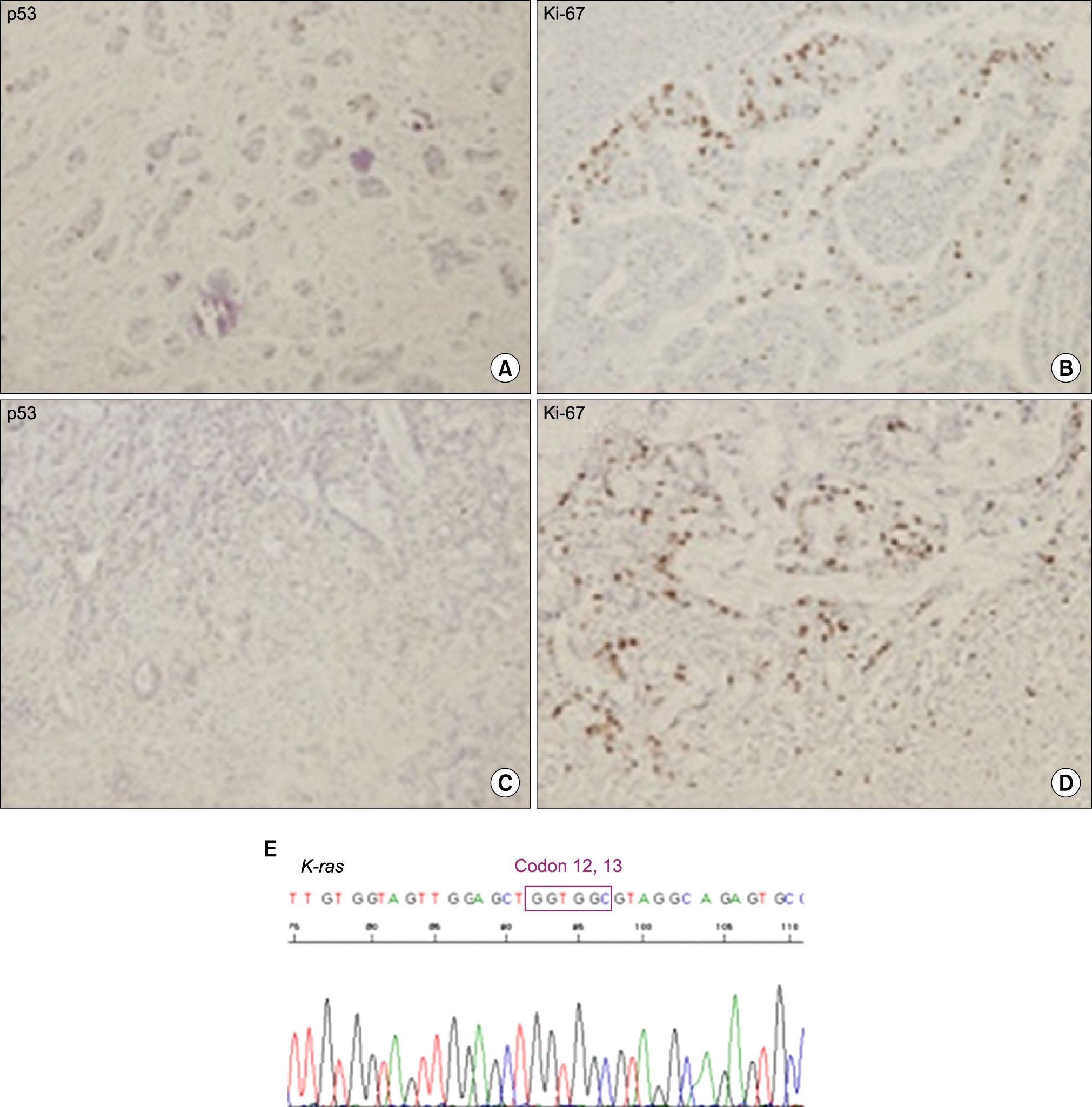 Immunostaining of tumor. p53 and Ki-67 immunostaining (×100; A, B, common bile duct cancer; C, D, gallbladder cancer) and K-ras mutation analysis (E).