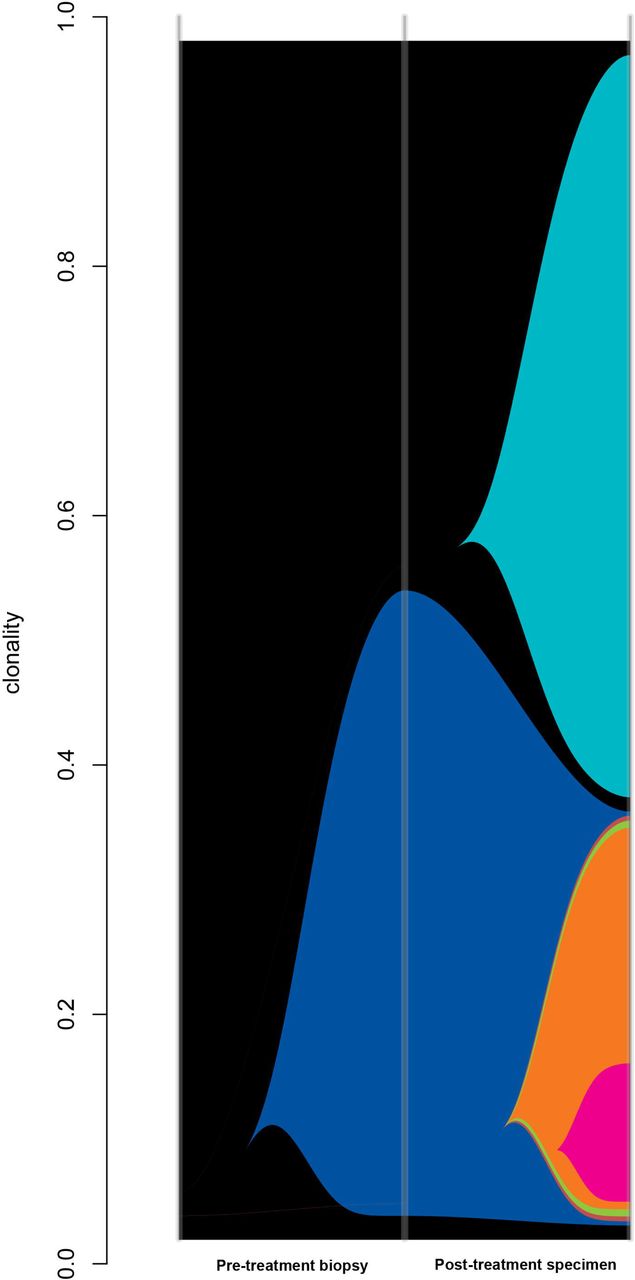 Example river plot of poorly responding cancer; Pre-treatment biopsy demonstrates one clone in sample (clonality 0.57); post treatment specimen shows multiple (five more) clones evolving as a result of radiotherapy selection pressure.