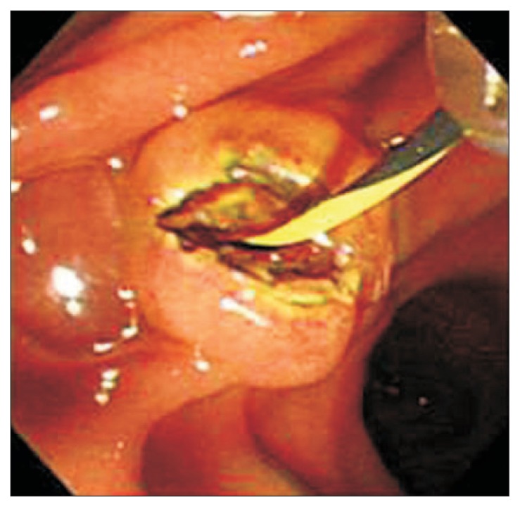 A patient who underwent infundibulotomy developed hyperamylasemia (case 6).