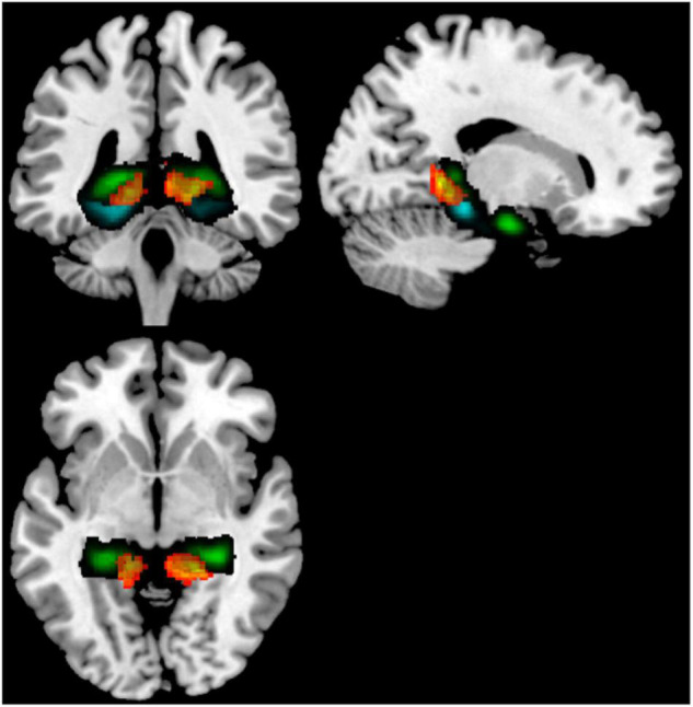 Seed-to-voxel analysis contrasting older users vs older non-users, illustrating increased rsFC from a cerebellum 4/5 seed to a cluster (warm colors) overlapping the hippocampus (green) and posterior parahippocampal cortex (cyan). Target regions derived from the Harvard-Oxford atlas. Illustrated slices from X = 184, Y = 135, Z = 132.