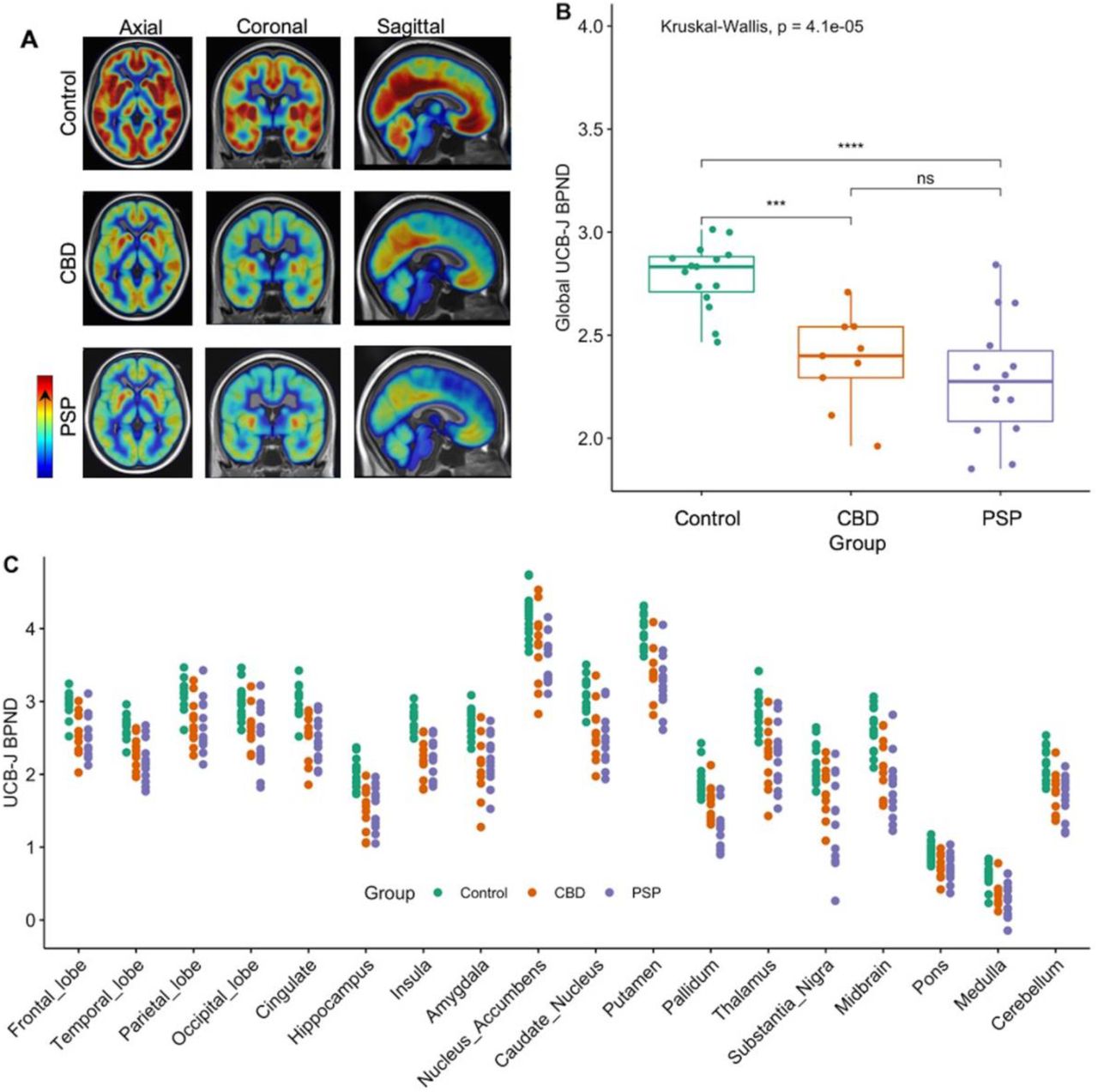 (A) Mean [11C]UCB-J BPND maps for control participants (top row), CBD (middle row), and PSP (bottom row); high and low BPND values are shown by red and blue areas, respectively.(B) Reduction in global [11C]UCB-J BPND across patients compared to controls (P<0.05).(C) Individual regional GTM PVC [11C]UCB-J BPND values for control, CBD and PSP participants, across major regions of interests. Binding potential values for patients differed significantly from controls in all the regions depicted (P<0.05, FDR corrected).