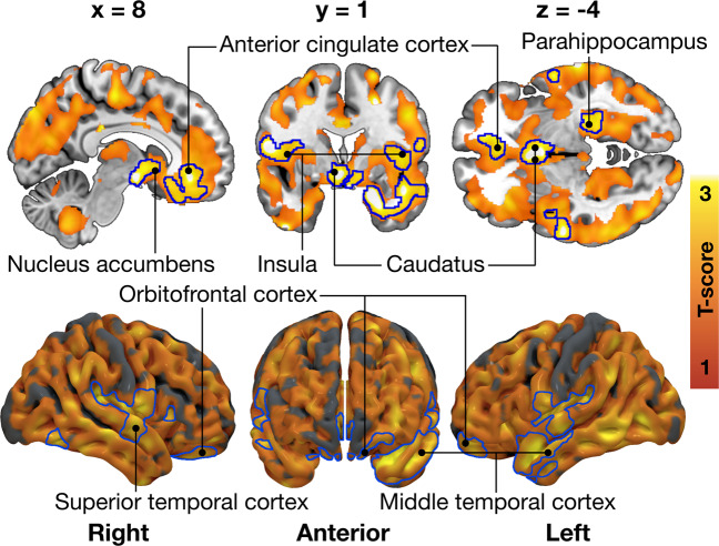 Total Dutch Eating Behavior Questionnaire (DEBQ) score associated with decreased CB1 receptor availability in the 35 males scanned with [18F]FMPEP-d2.The blue outline marks brain regions where lower [18F]FMPEP-d2 volume of distribution (VT) associated with higher Total DEBQ score, age as a nuisance covariate, cluster forming threshold p < 0.01, FWE corrected. In the red–yellow T-score scale shown are also additional associations significant with more lenient cluster-defining threshold (p < 0.05, FWE corrected) for visualization purposes.