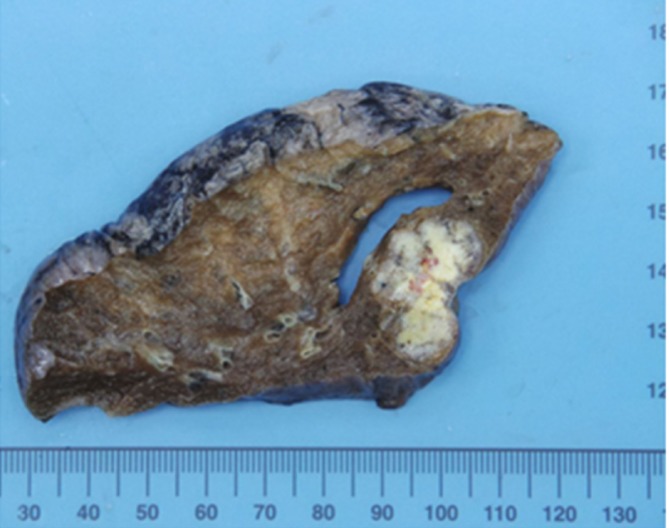 Macroscopic ﬁndings of lung-resected specimens.