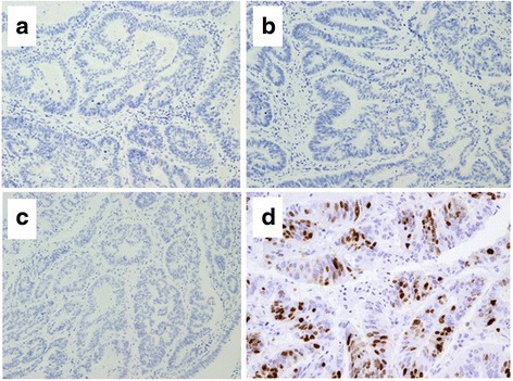 Immunohistochemical findings in the component of LCNEC. a Immunostaining for synaptophysin was partially positive. b Immunostaining for chromogranin A was negative. c Immunostaining for CD56 was strongly positive in most of the LCNEC cells. d Immunostaining for Ki-67 was strongly positive in 72% of the LCNEC cells