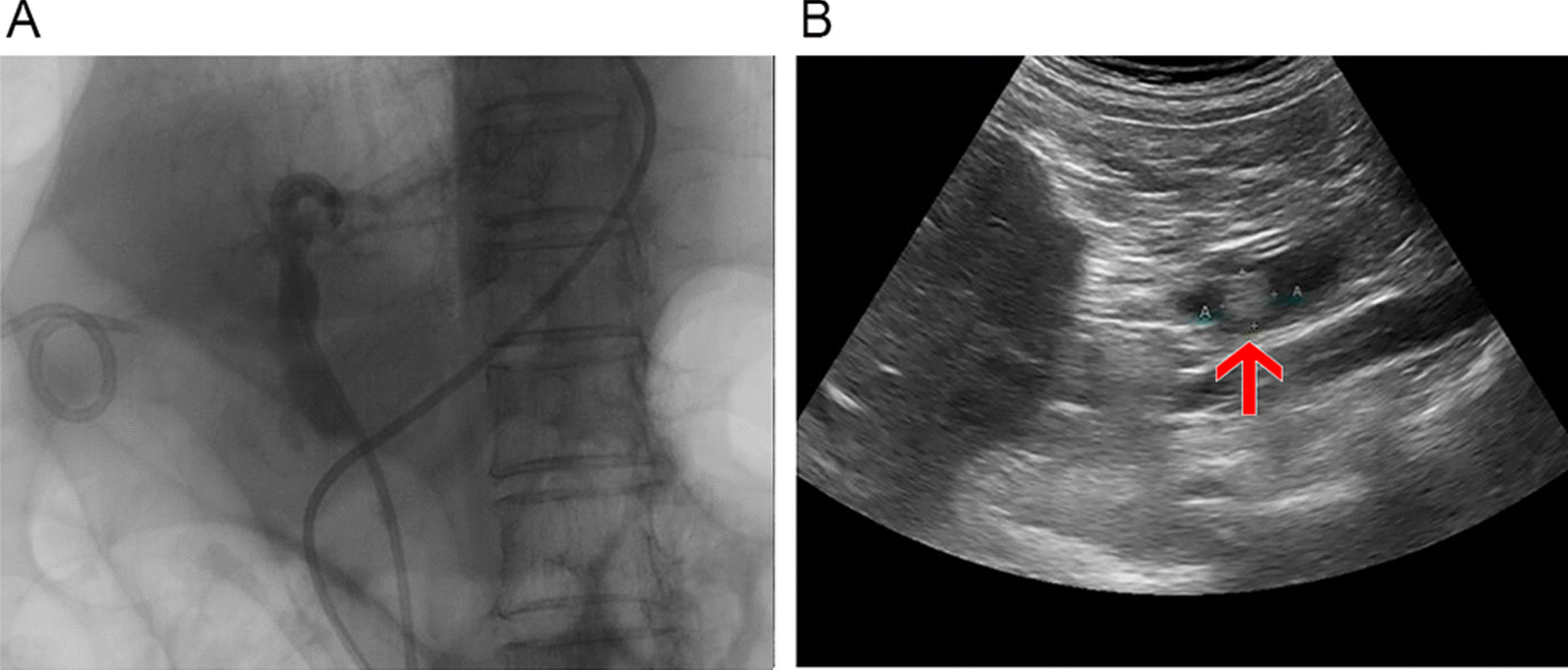 Comparison between occlusion cholangiogram and ENBD saline injection in ultrasounds in a 78-year-old women. A. There are no significant stones found in occlusion cholangiogram. B. Remnant stone is found by ENBD saline injection ultrasound