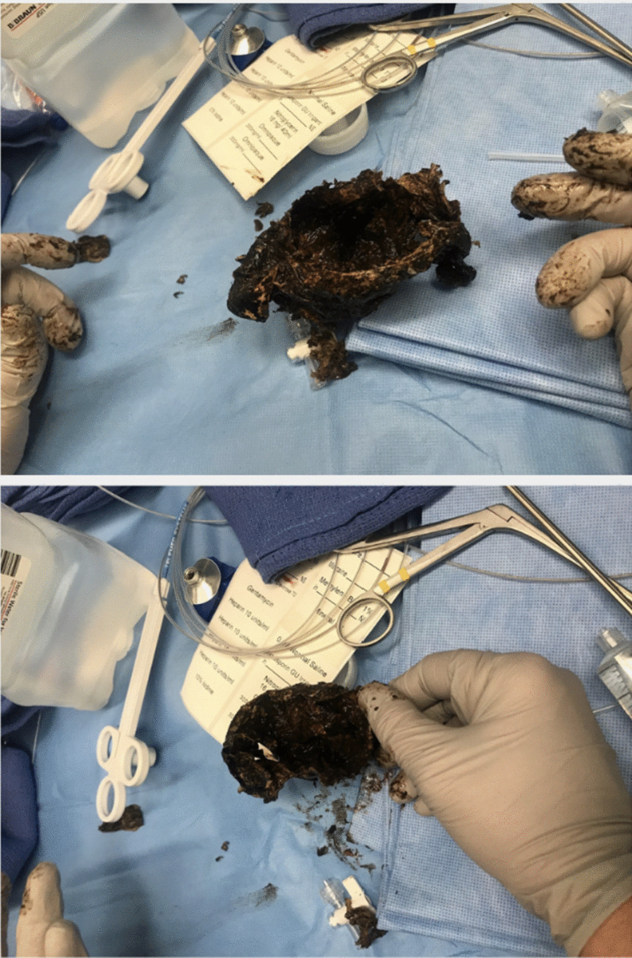 Bagged marijuana removed via endoscopy