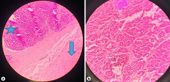 Histopathological examination of choledochal cyst showing areas of fibrosis (arrow) with pancreatic acini (star) in the wall of a choledochal cyst (×200) (a) and pancreatic acini in the wall of a choledochal cyst (×400) (b).