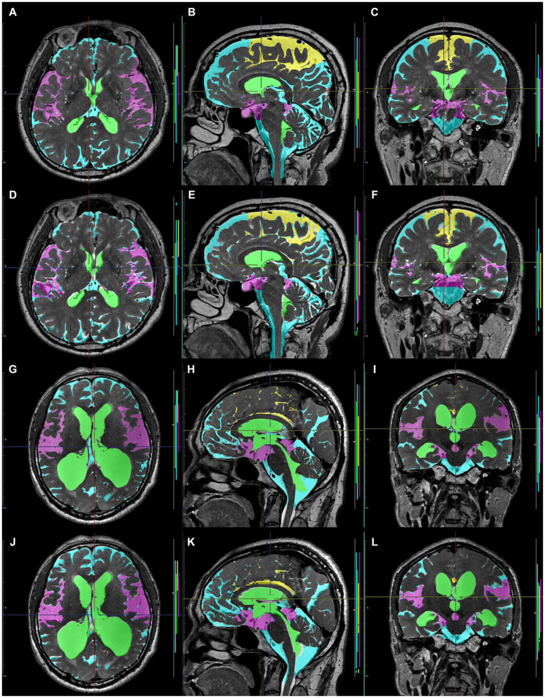 Comparison between manually and automatically segmented regions from 3D T2-weighted images. 3D T2-weighted images in a representative healthy volunteer (A–F) and a representative patient with Hakim disease and DESH (G–L): manually segmented (A–C,G–I) and automatically segmented (D–F,K–L) volumes of the total ventricles (green); Sylvian fissure and basal cistern (purple); high-convexity part of the subarachnoid space (yellow); other subarachnoid spaces (marine blue) from 3D T2-weighted images.