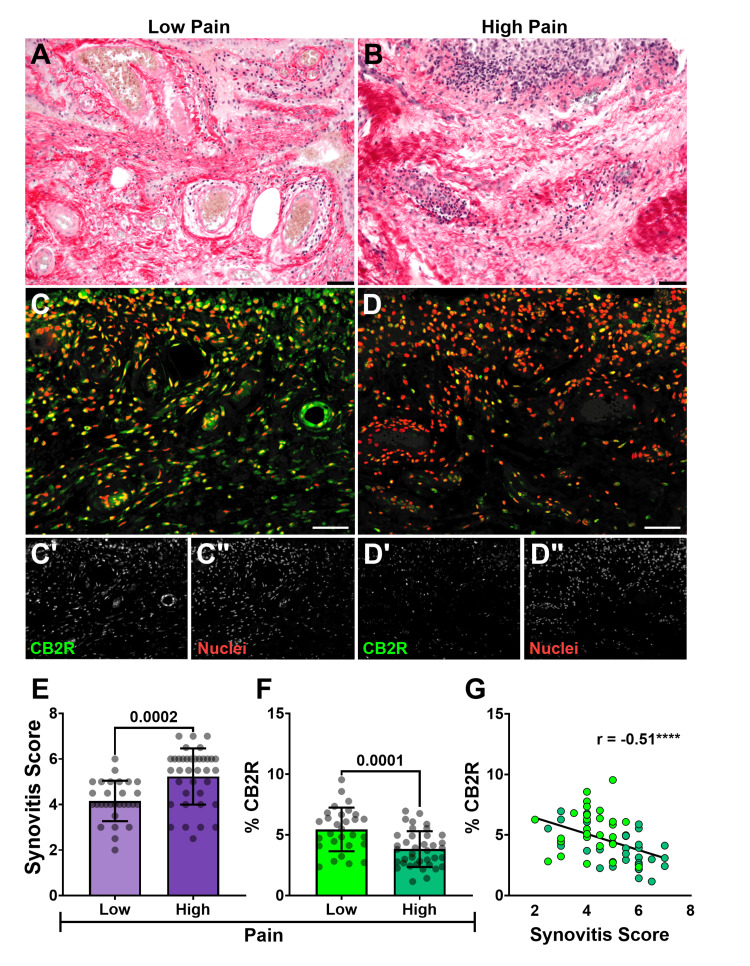 Histological synovitis and CB2R distribution relative to KOOS pain(A) Representative PS-stained sections of synovium from patients showing synovitis severity corresponding to (A) low (KOOS Q3 ≥ 47.20) and (B) high (KOOS Q1 ≤ 22.20) self-reported pain (bars = 50 µm). Confocal photomicrographs captured at 200× corresponding to PS-stained synovium sections of patients from the (C) low and (D) high-pain cohorts stained for CB2R (green) (C’ and D’ in grayscale) and nuclei (red) (C” and D” in grayscale) (bars = 100 µm). (E) Comparison of mean ± SD synovitis score between low and high KOOS pain groups (Student's t-test, α =0.05). (F) Bar graph with individual data points comparing mean ± SD percentage of CB2R signal (normalized to cell number) between KOOS pain groups (Student's t-test, α =0.05). (G) A scatterplot with linear regression analysis demonstrates a negative correlation between synovitis score and histological CB2R expression. Pearson correlation coefficient (r) with ***p < 0.0001.PS: Picrosirius, KOOS: Knee Injury and Osteoarthritis Outcome Score, CB2R: cannabinoid receptor type 2, SD: standard deviation