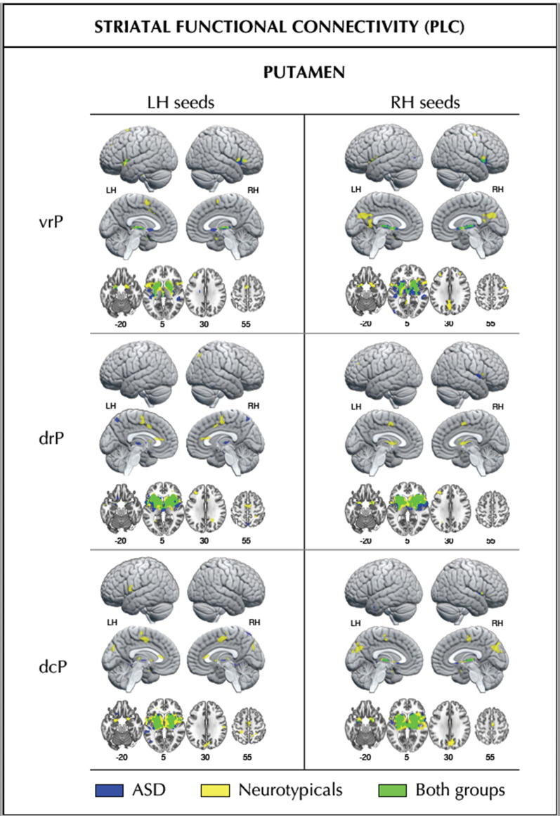 Baseline striatal (putamen) functional connectivity within each participant group. Striatal (putamen) functional connectivity at placebo in the ASD group (blue), the neurotypicals (yellow), and the overlap of both groups (green). Numbers below slices indicate Montreal Neurological Institute (MNI) z-coordinates. dcP dorsal-caudal putamen, drP dorsal-rostral putamen, LH left hemisphere, RH right hemisphere, vrP ventral-rostral putamen