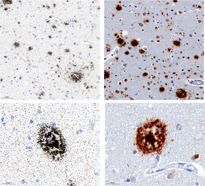 Micro-ARG in brain section from an AD donor with [3H]KAC-50.1 revealed accumulation of silver grains on Aβ plaques.