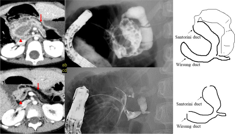 Case 1. Computed tomography (CT) and endoscopic retrograde cholangiopancreatography (ERCP) images of a 3.1-year-old patient are shown in (a) and (b). Pancreatic stones were found in the pancreatic head, and the pancreatic duct was dilated. CT and ERCP images at 6.3 years of age are shown in (c) and (d). Atrophy of the tail of the pancreas and decreased exocrine function were also observed. Several ERCP attempts were in vain; thereafter, Longitudinal pancreaticojejunostomy with coring-out of the pancreatic head (Frey’s procedure) was performed at 7-years of age, and there has been no occurrence of pancreatitis since. Arrowhead: pancreatic head, pancreatic duct; Arrow: pancreatic tail