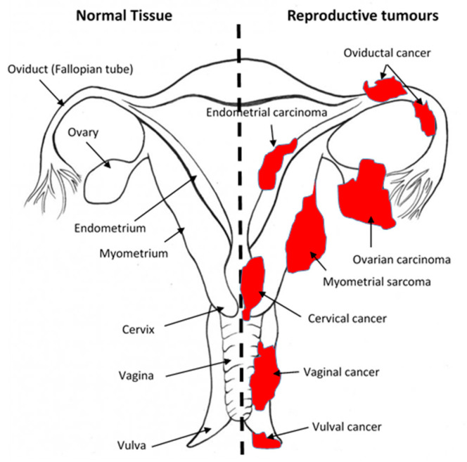 Sites of gynaecological cancers in the female reproductive tract. The diagram indicates the names of the normal tissues of the female reproductive tract (left side) and the sites and names of the cancers (right side) for the corresponding normal tissues. Please add copyright if necessary.