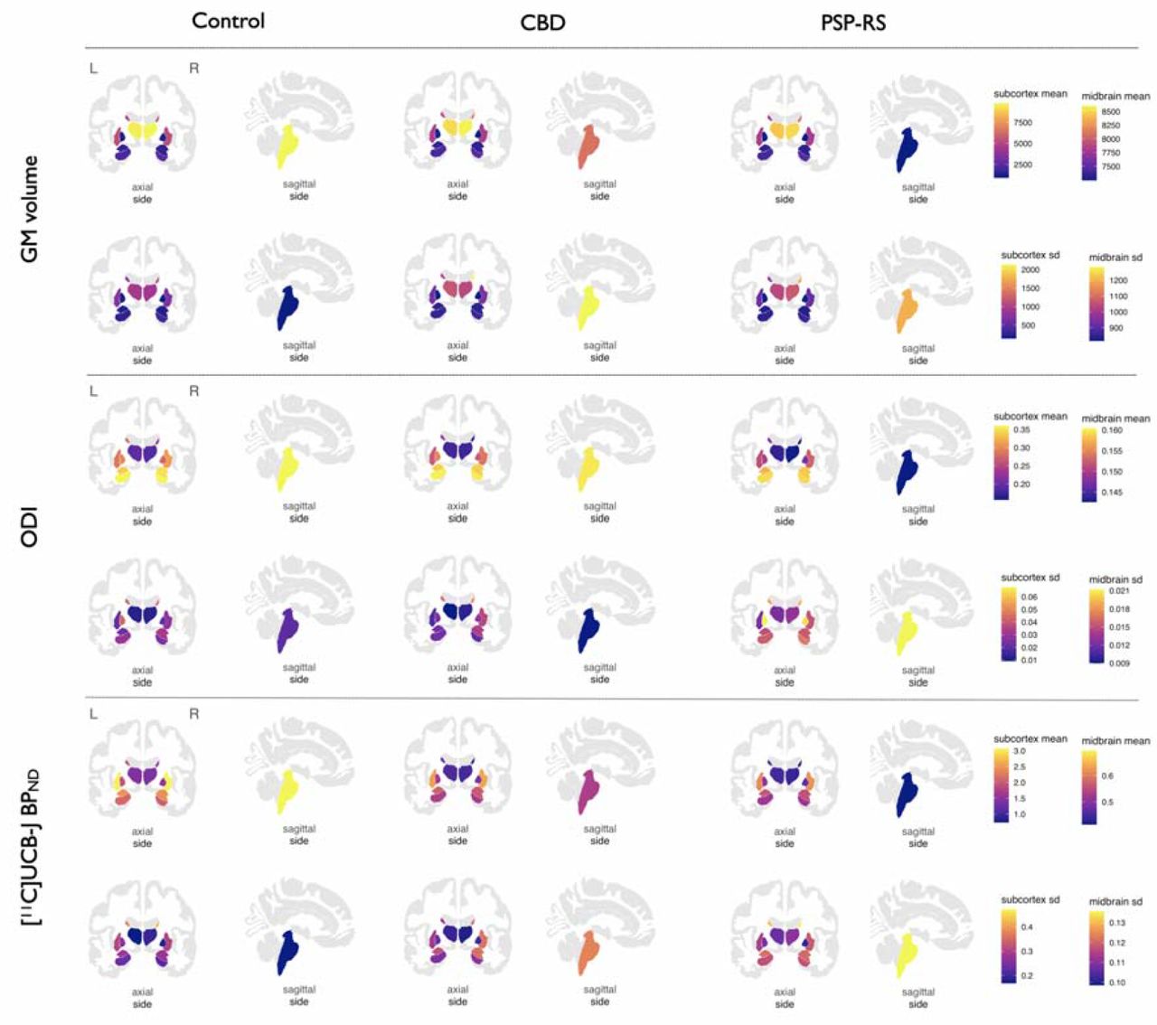 Subcortical distributions of grey matter volumes, ODI and [11C]-UCB-J BPND across controls, CBD, and PSP-RS.Abbreviations: ODI = Orientation Dispersion Index, CBD = amyloid negative Corticobasal Syndrome; PSP-RS = Progressive Supranuclear Palsy-Richardson’s Syndrome; sd = standard deviation; GM = grey matter. For ease of visualisation the colours in the brainstem represent the midbrain only.