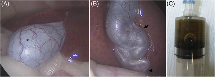 The figure shows the case with the highest activity of bile AMY and LIPA. Observed laparoscopically, the gallbladder had normal morphology (A); however, dilatation and tortuosity were observed throughout the cystic duct (arrow) and common bile duct (arrowhead; B). The bile sample collected by bile puncture was the largest in the study, at 4.5 mL of light‐brown bile (C). AMY, amylase activity; LIPA, lipase activity
