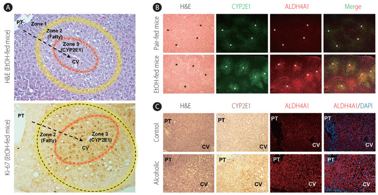 Hepatic zonal-dependent expression of CYP2E1 and ALDH4A1 in mice and patients with ALD. (A) After chronic alcohol consumption (4.5% of EtOH containing diet feeding for 8 weeks), fat accumulation is mainly observed at zone 2, whereas hepatic proliferation (Ki-67-positive) is mostly detected in zone 3 in stained liver sections of EtOH-fed mice. Arrows and asterisks indicate direction of blood flow and central veins, respectively. (B, C) Increased expression of CYP2E1 and ALDH4A1 is typically perceived around central veins of liver sections in EtOH-fed mice and alcoholic patients compared to their corresponding controls. Original magnification, ×200. H&E, Hematoxylin & Eosin; PT, portal area; CYP2E1, cytochrome P450 2E1; CV, central vein.