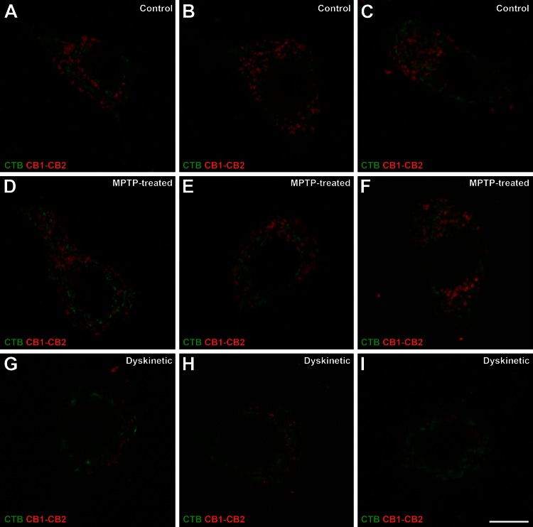 CB1R–CB2R heteromers in pallidothalamic-projecting neurons of control, parkinsonian and dyskinetic monkeys. Illustrative examples of identified projection neurons (CTB-labeled; green) taken from control (a–c), MPTP-treated (d–f) and dyskinetic (g–i) monkeys. Each red dot represents one CB1R–CB2R receptor heteromer. Scale bar is 10 μm in all panels
