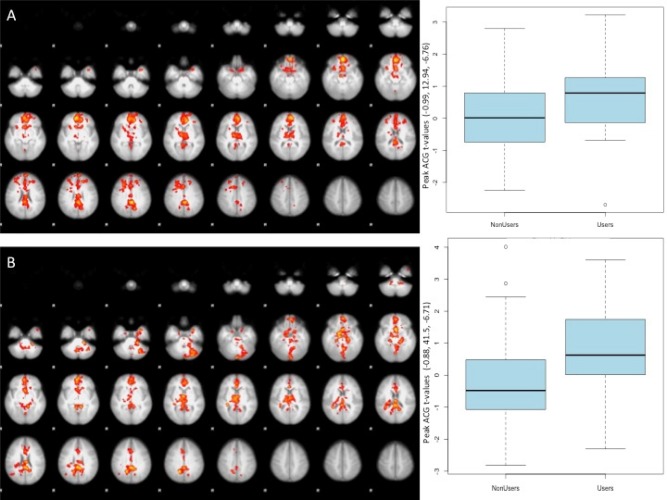 Effect between cues (cannabis cues, fruit cues, and neutral cues) and group (users, non‐users). Cannabis cues relative to (A) fruit cues and (B) neutral cues in the users compared to non‐users. The box and whisker plots show the range of Gaussianized t‐scores in the overlapping anterior cingulate gyrus peaks for both groups. Boxes represent the middle quartiles (Q1–Q3) with the bar at the median. Whiskers show the full range of values, with circles representing “outlier” scores for this peak (i.e., more than 3 SD from the median value) (cluster‐threshold z = 2.3, P < 0.05 FWE‐corrected).
