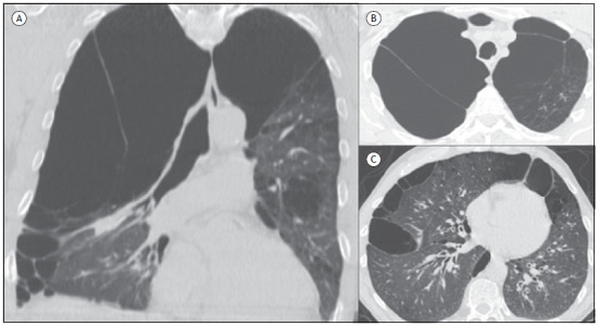 Chest CT scans with coronal (A) and axial (B and C) reconstructions showing large emphysematous bullae predominating in the upper fields of the lungs, the largest one in the right lung.