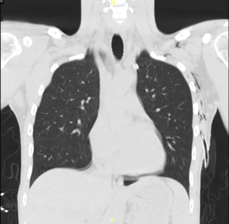 Computerized tomography of the thorax with chest thoracostomy. Left-side chest thoracostomy with the appearance of the abutted sympathetic nerve.