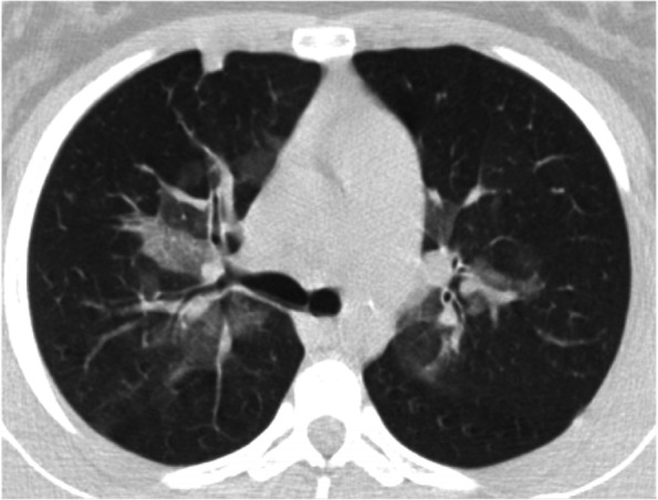 Chest CT (axial view) confirmsing the central ground glass. A small consolidation is evident anteriorly on the right
