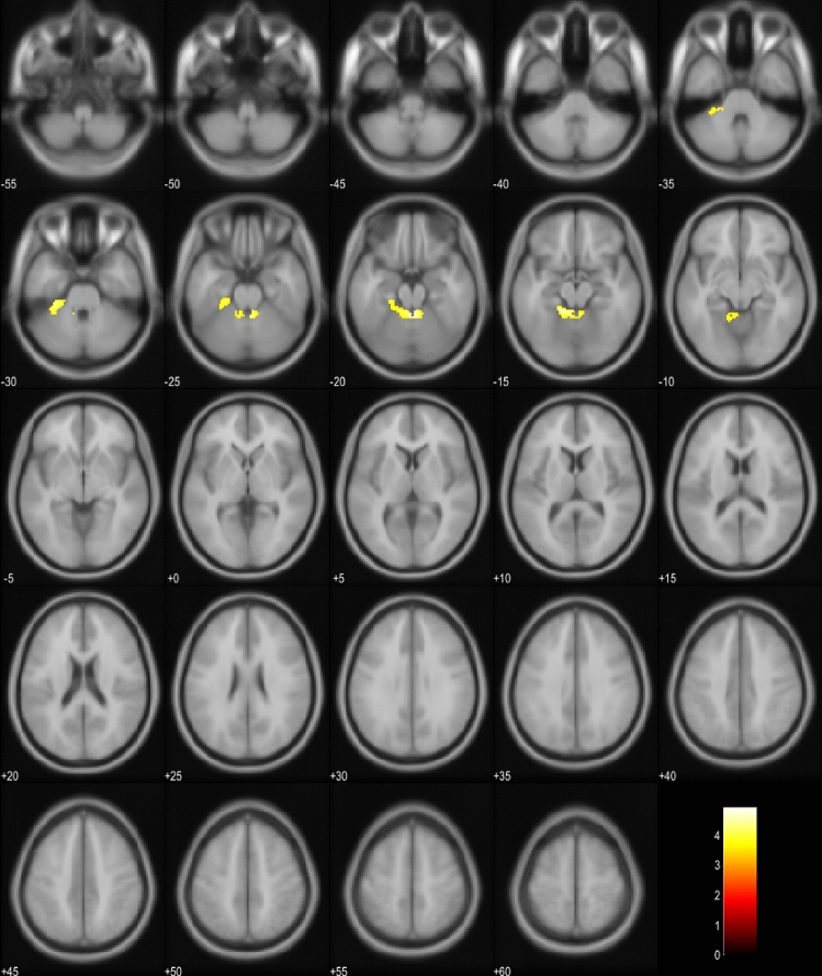 Hypometabolism in bvFTD patients with EP symptoms compared to PSP and CBD patients. Orange and yellow colors represent lower metabolism in the bvFTD group (p < 0.001, uncorrected). Images are presented in neurological orientation (i.e., left hemisphere presented in left side of the picture)