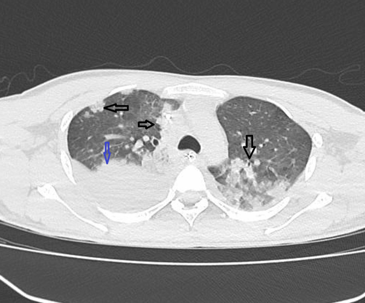 CT chest showing bilateral pulmonary infiltrates and right-sided effusion.The blue arrow shows right-side effusion and the black arrows show bilateral infiltrates.