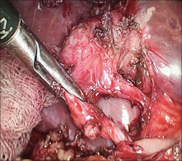 Intraoperative picture during laparoscopic completion cholecystectomy that displays residual gallbladder with a triangle of safety after Calot's triangle dissection.