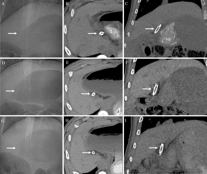 Representative images of 1-month (A–C), 2-month (D–F), and 3-month (G–I) follow-up CT scans to evaluate the status of biodegradable stents. The scout images (A,D,G), precontrast axial images (B,E,H), and coronal reconstruction images (C,F,I) show a radiopaque stent in the common bile duct without complications.